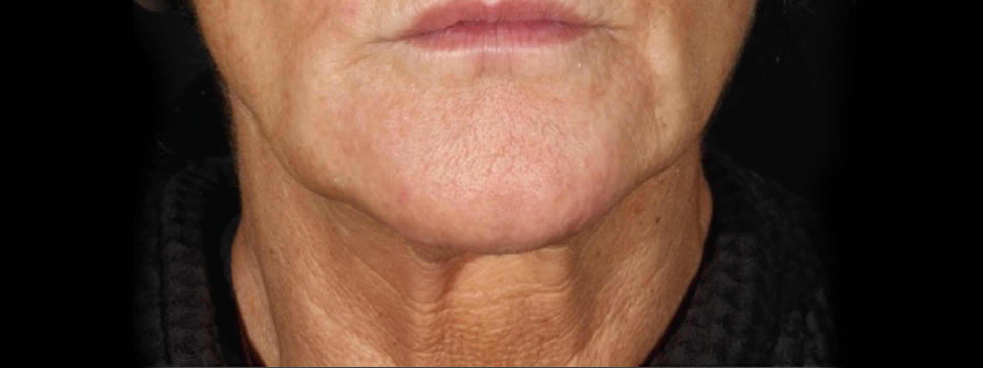 Facial Skin Tightening & Contour Improvement - After XERF Treatment