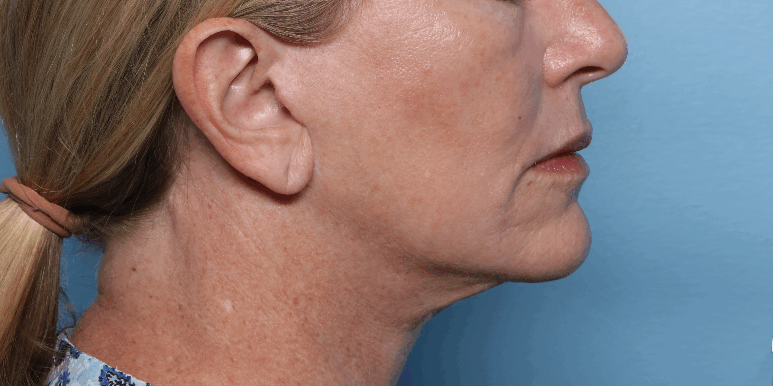 Lower Face & Jawline Definition - After XERF Treatment