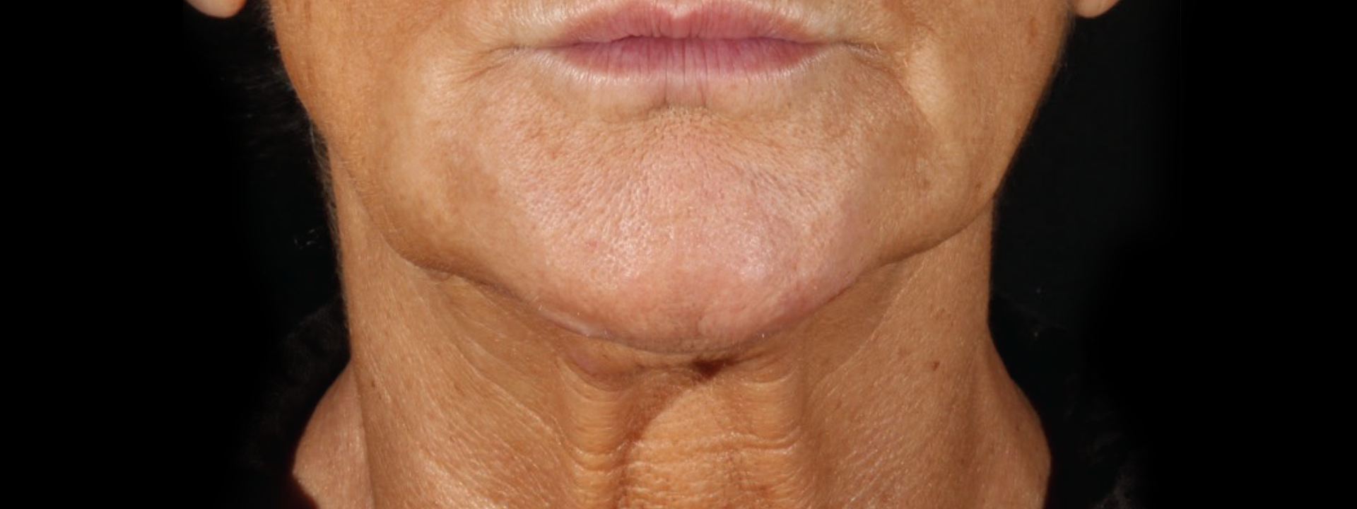 Facial Skin Tightening & Contour Improvement - Before XERF Treatment