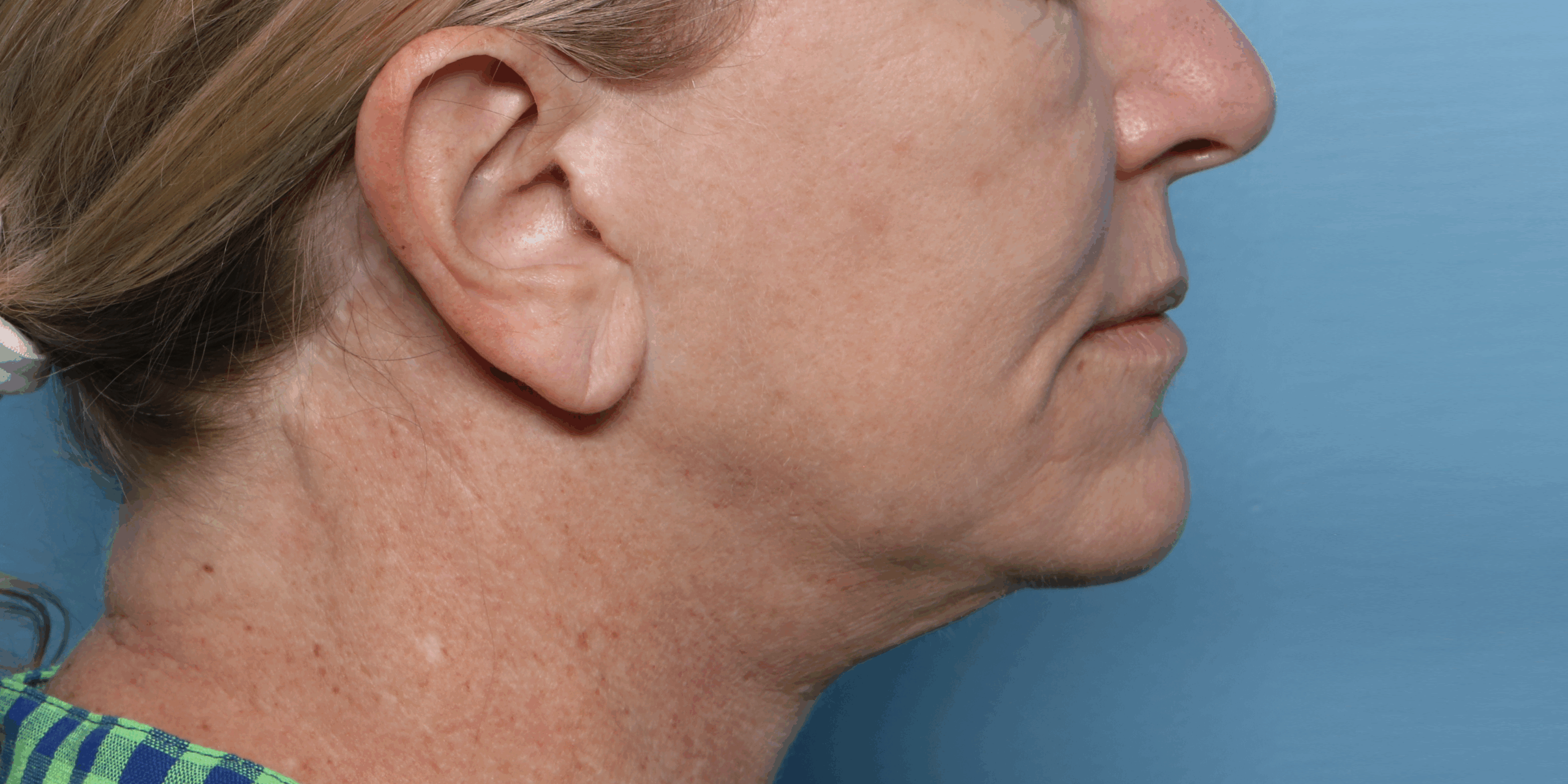 Lower Face & Jawline Definition - Before XERF Treatment